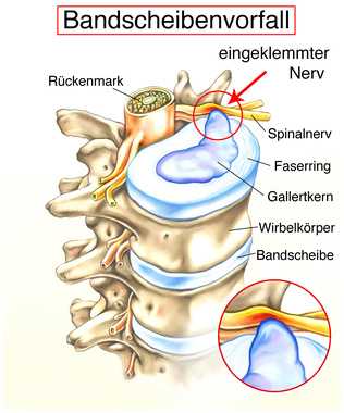 Bandscheibenvorfall